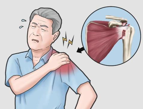 治疗肩袖损伤的中药外敷方法